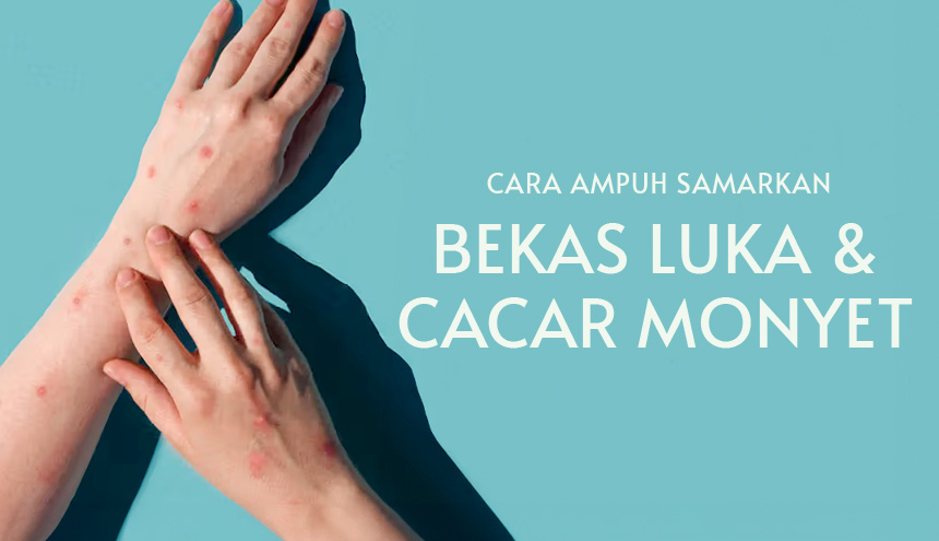 8 Cara Ampuh Menyamarkan Bekas Luka Cacar, No More Insecure!