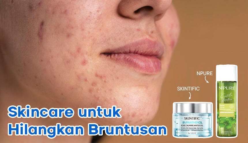 12 Rekomendasi Skincare untuk Menghilangkan Bruntusan di Wajah